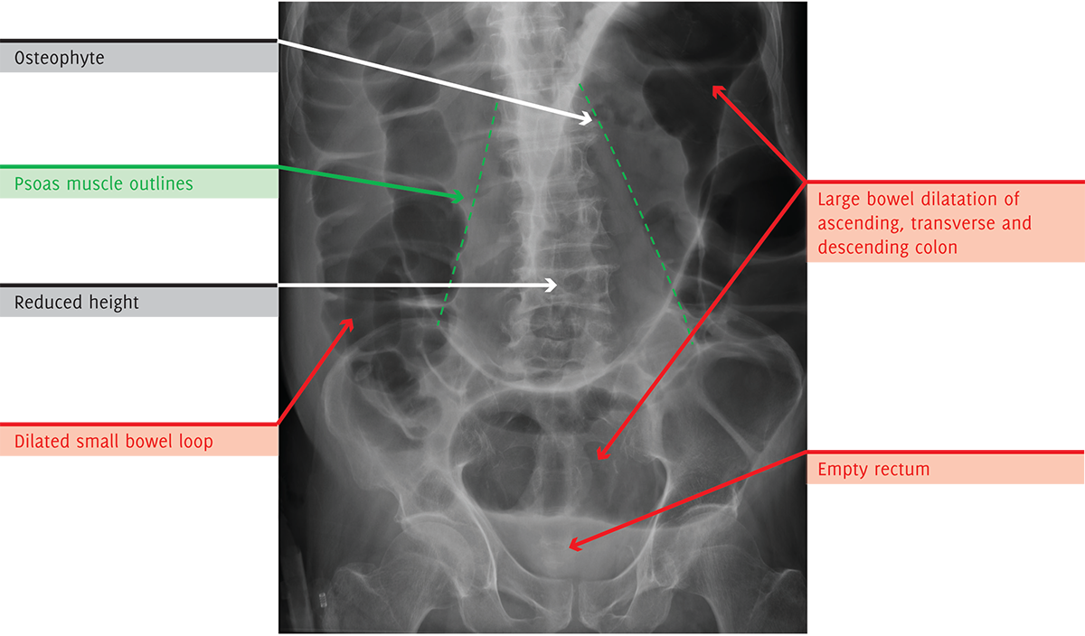 Annotated Cervical Spine X Ray With Directional Medical Labels PNG Diagram