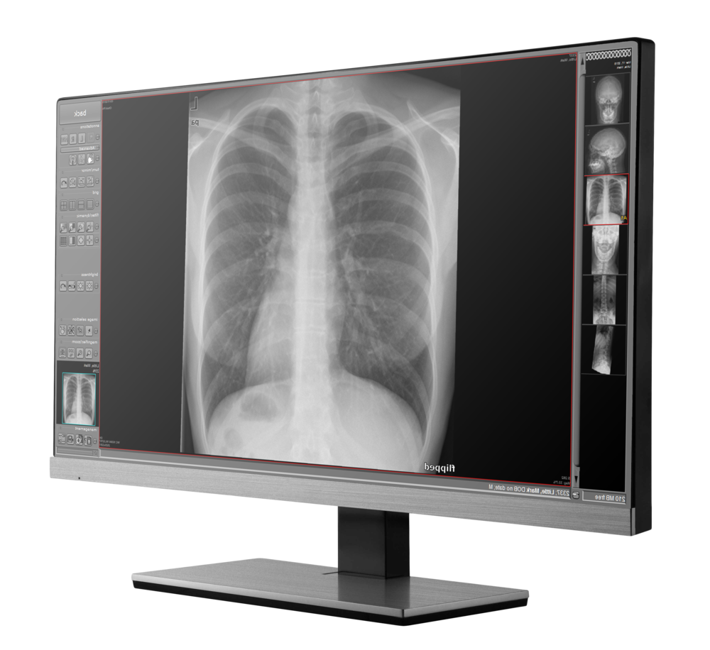 Chest Radiograph Displayed On Desktop Diagnostic Monitor PNG Medical Photo