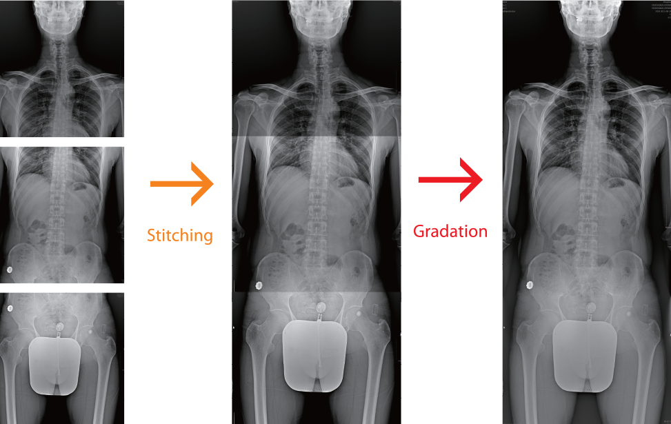 Full Body X-Ray Stitching Process Grayscale