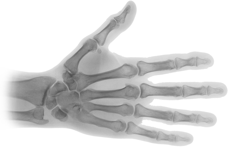 Gray Hand Skeleton X Ray Showing Finger And Wrist Bones PNG Illustration